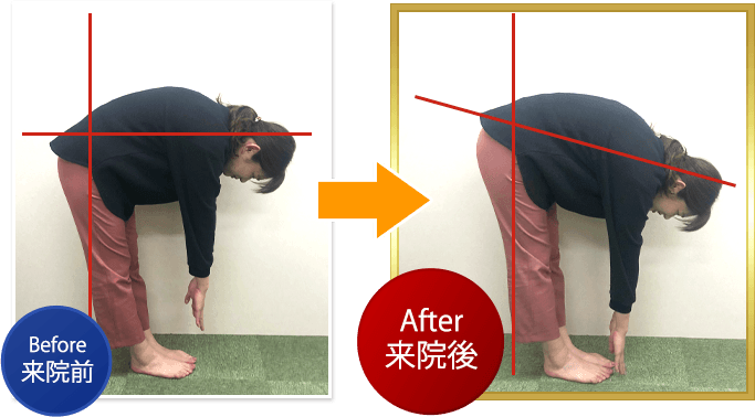 痛みでほとんど反れなかった腰が 楽に反れるようになりました。